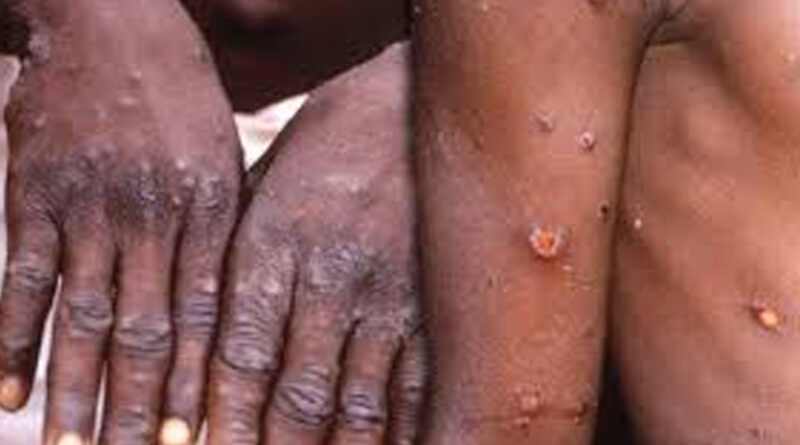 Moçambique confirma primeiros três casos do actual surto